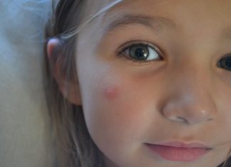 The Alternative Remedies for Bug Bites